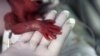 Study: Premature Babies Often Catch Up to Peers in School 